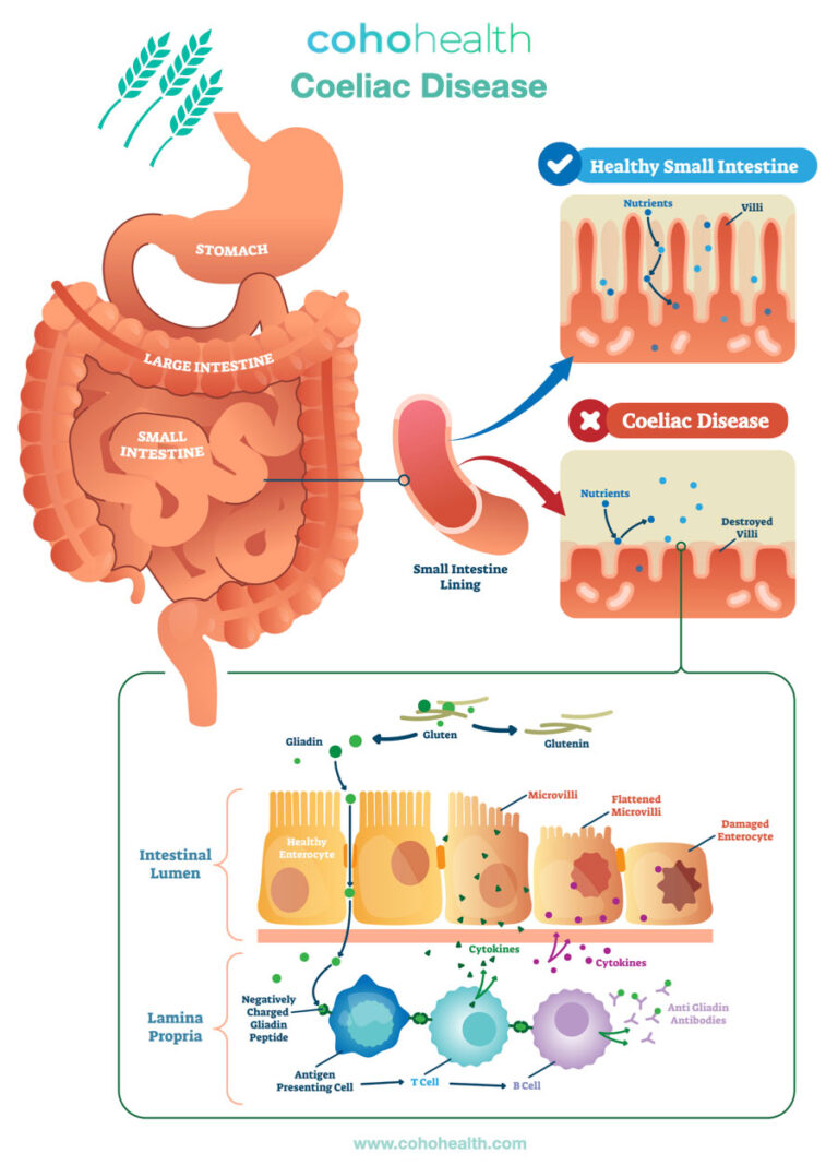 Coeliac Disease How Functional Medicine Can Help You